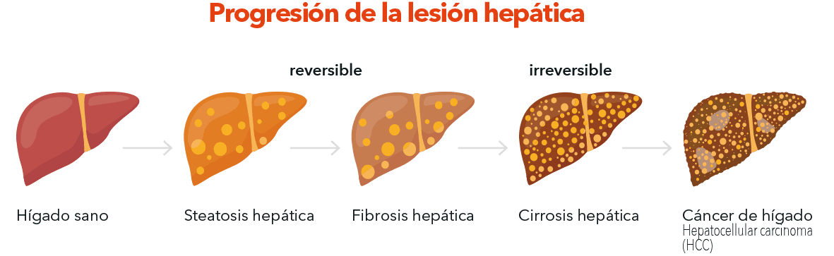 Progresión de la lesión hepática...